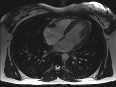 heart-disease-deep-learning_m
