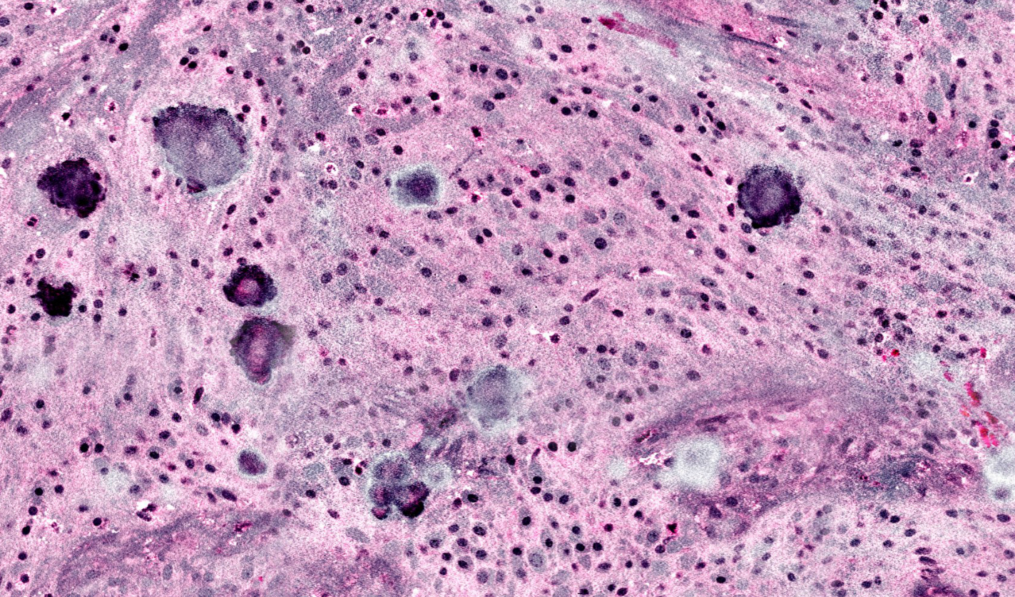 ai-helps-improve-brain-tumor-diagnosis_s