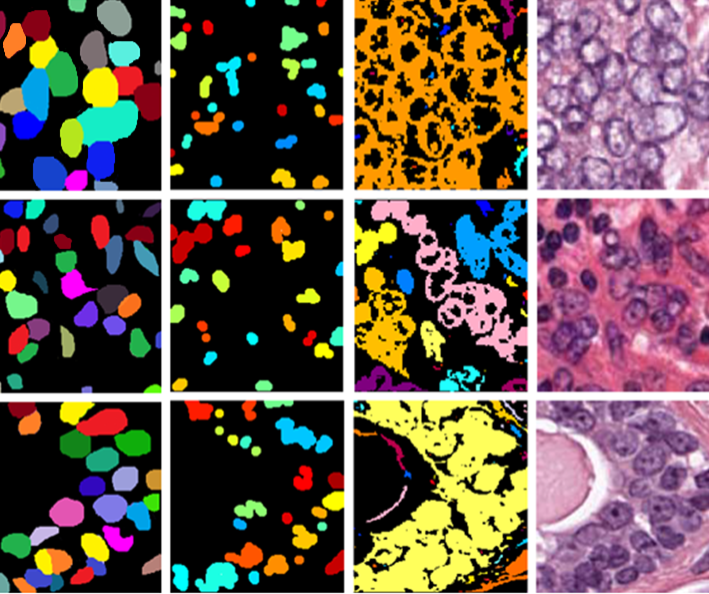 ai-pathologist-helps-zero-in-on-correct-cancer-diagnosis_m