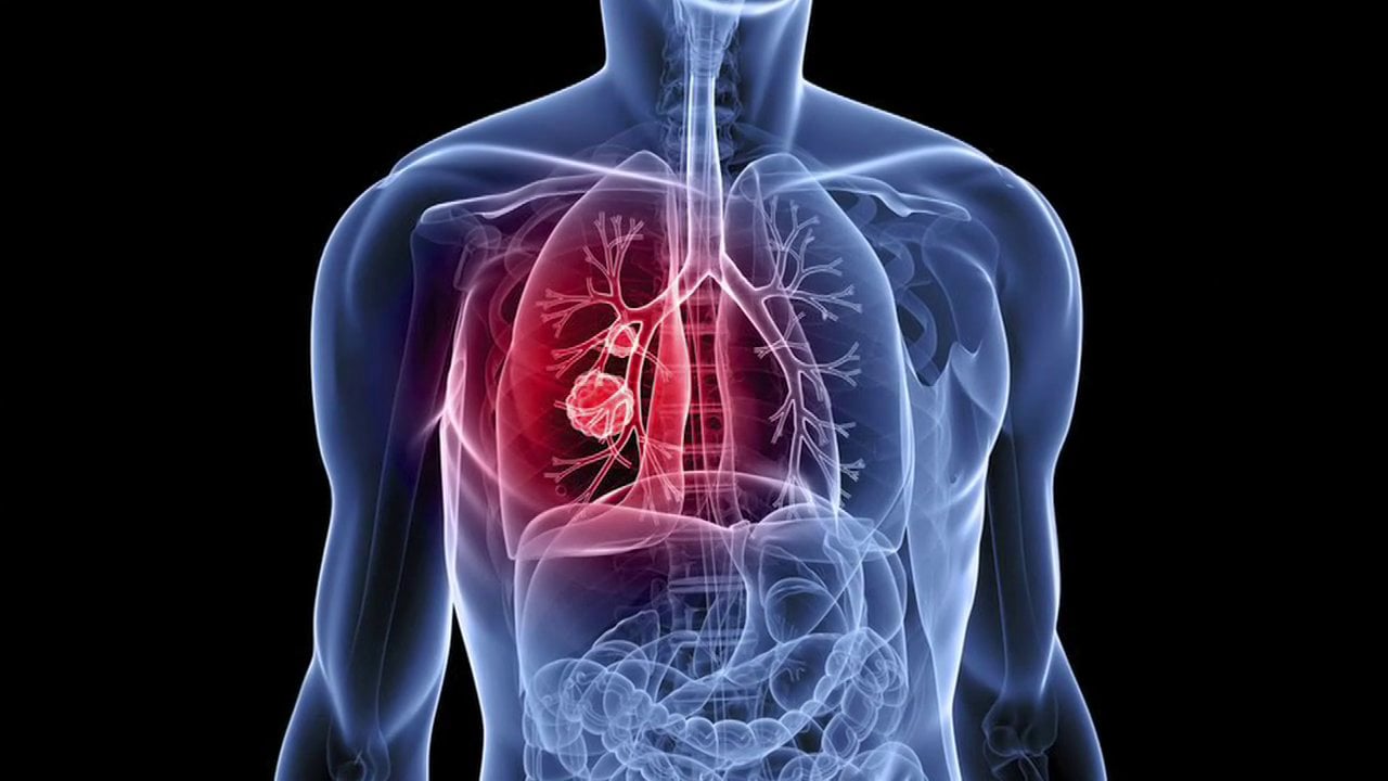 lung-cancer-data-science-bowl_m