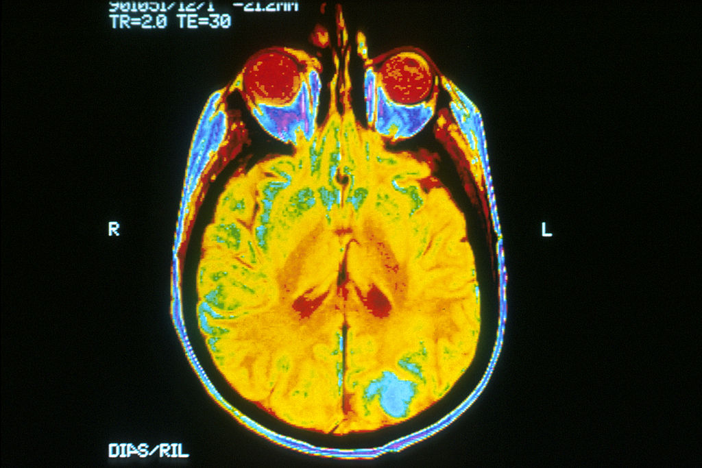 ai-to-predict-brain-tumor-genomics_m