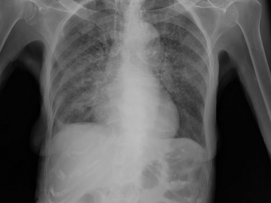 fighting-tuberculosis_m