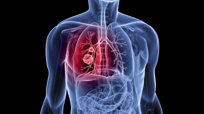 detect-cancer-from-ct-scans_m
