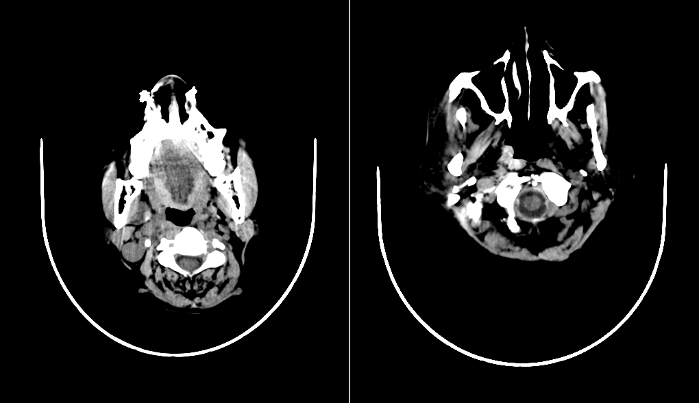 intracranial-subdural-modified_m