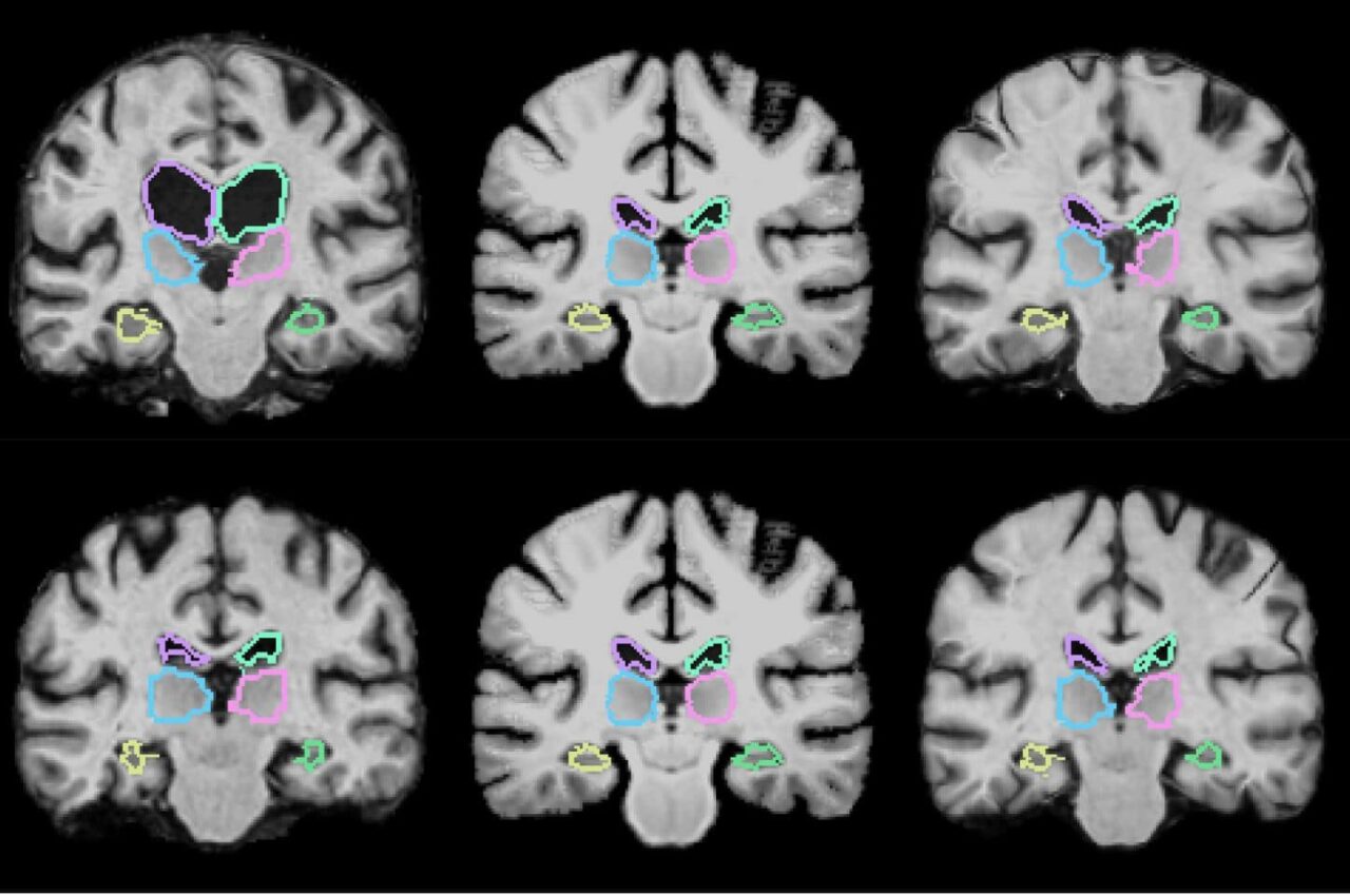 3DMRIbrain-1280x850
